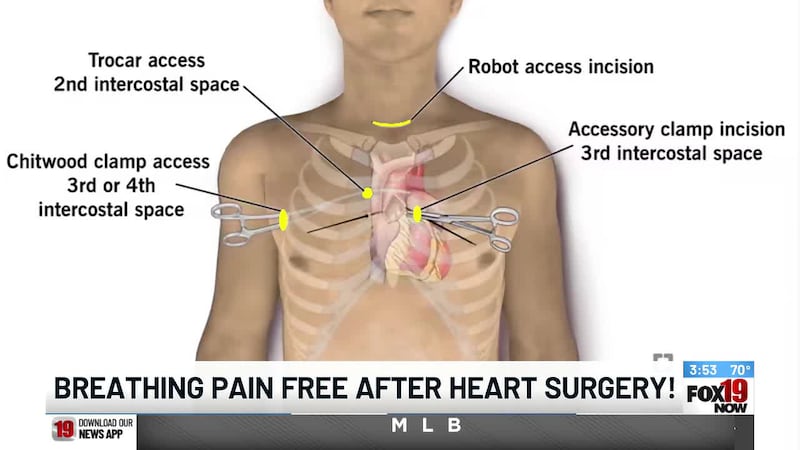 Breathing pain-free after heart surgery